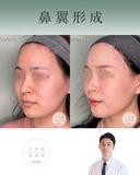 鼻翼縮小 after画像 サムネイル用