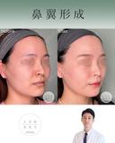 鼻翼縮小 after画像 サムネイル用