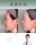 鼻翼縮小 after画像 サムネイル用