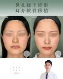 鼻孔縁下降術＋耳介軟骨移植 after画像 サムネイル用