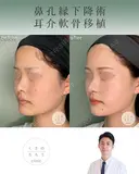 鼻孔縁下降術＋耳介軟骨移植 after画像 サムネイル用