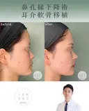 鼻孔縁下降術＋耳介軟骨移植 after画像 サムネイル用