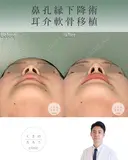 鼻孔縁下降術＋耳介軟骨移植 after画像 サムネイル用