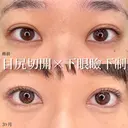 MD式目尻切開＋MD式下眼瞼下制（結膜切開） 90日後 サムネイル用