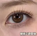 BELINDA二重術 after画像 サムネイル用