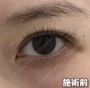 BELINDA二重術 before画像 サムネイル用