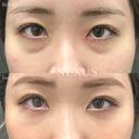 切らない目の下のたるみ取り＋脂肪注入 before画像 サムネイル用