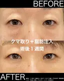 人気のクマ取り＋脂肪注入 before画像 サムネイル用