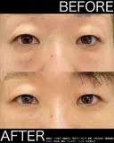 人気のクマ取り＋脂肪注入 7日後 サムネイル用