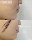 Cカールリップ(ヒアルロン酸注入) after画像 サムネイル用