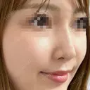 鼻のヒアルロン酸注入 after画像 サムネイル用
