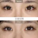 目頭切開 after画像 サムネイル用