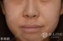 【小鼻縮小術】1ヶ月後 before画像 サムネイル用