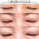 華やかで永続的な二重に💖二重切開VOGUE法 before画像 サムネイル用