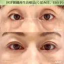 半永久的✨シワ改善（成長因子注入）くぼみ目 before画像 サムネイル用