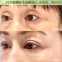 半永久的✨シワ改善（成長因子注入）くぼみ目 after画像 サムネイル用