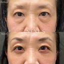 切開ハムラ法＋脂肪注入 before画像 サムネイル用