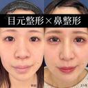 MD式たるみ取り併用全切開二重術、MD式目頭切開、涙袋ヒアルロン酸、プロテーゼ、鼻尖形成３D法、軟骨移植、小鼻縮小内外側法 before画像 サムネイル用