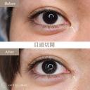 目頭切開 before画像 サムネイル用