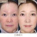 小鼻縮小(鼻翼縮小切開法) before画像 サムネイル用