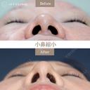 小鼻縮小(鼻翼縮小切開法) 30日後 サムネイル用