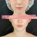 顔の脂肪吸引（ジョールファット・メーラーファット除去） before画像 サムネイル用