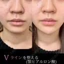 顎ヒアルロン酸注入｜Vラインを整える before画像 サムネイル用