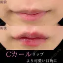 Cカールリップ｜より可愛い口角に💋 before画像 サムネイル用