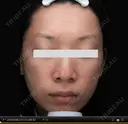 30歳_プラズマ(VC)4／9回 before画像 サムネイル用