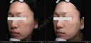 30歳_プラズマ(VC)4／9回 after画像 サムネイル用