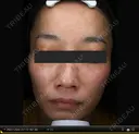 47歳_肝斑パーフェクト7回+取り放題 before画像 サムネイル用