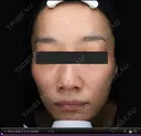47歳_肝斑パーフェクト7回+取り放題 after画像 サムネイル用
