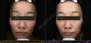 47歳_肝斑パーフェクト7回+取り放題 after画像 サムネイル用