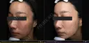 47歳_肝斑パーフェクト7回+取り放題 after画像 サムネイル用