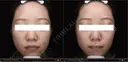 24歳_ニキビ集中4／9回 after画像 サムネイル用