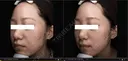 24歳_ニキビ集中4／9回 after画像 サムネイル用