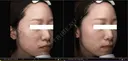 24歳_ニキビ集中4／9回 after画像 サムネイル用