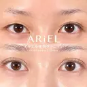 アリエルクイックループダブル（二重埋没法） after画像 サムネイル用