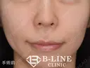 【人中短縮手術+小鼻縮小術】1ヶ月後 before画像 サムネイル用