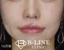 【人中短縮手術+小鼻縮小術】1ヶ月後 after画像 サムネイル用