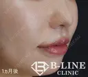 【人中短縮手術+小鼻縮小術】1ヶ月後 after画像 サムネイル用