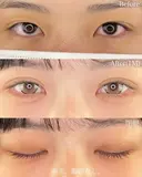 二重埋没法(エターナル二重術) after画像 サムネイル用