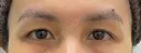 二重埋没 before画像 サムネイル用