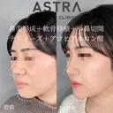 【大変身】隆鼻術・鼻尖形成・軟骨移植・小鼻切開・ヒアルロン酸（顎） after画像 サムネイル用
