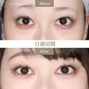 目頭切開 before画像 サムネイル用