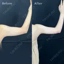 二の腕脂肪吸引 after画像 サムネイル用