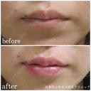 唇ヒアルロン酸 after画像 サムネイル用