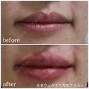 唇ヒアルロン酸注入 after画像 サムネイル用