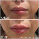 唇ヒアルロン酸 before画像 サムネイル用
