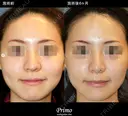 鼻尖縮小術 before画像 サムネイル用
